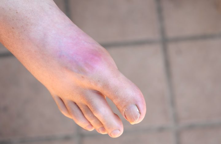 Homem com inflamação dolorosa da gota na articulação do dedo grande do pé.